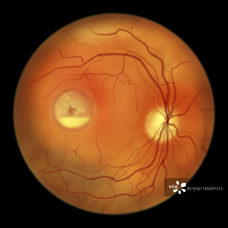 卵黄样黄斑营养不良插图图片素材