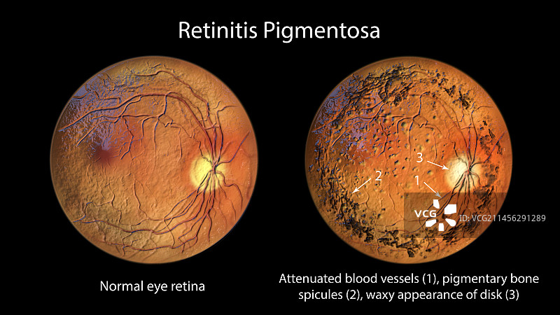 色素性视网膜炎图示图片素材