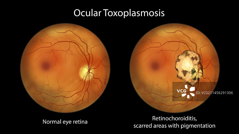 视网膜疤痕和健康的视网膜，插图图片素材