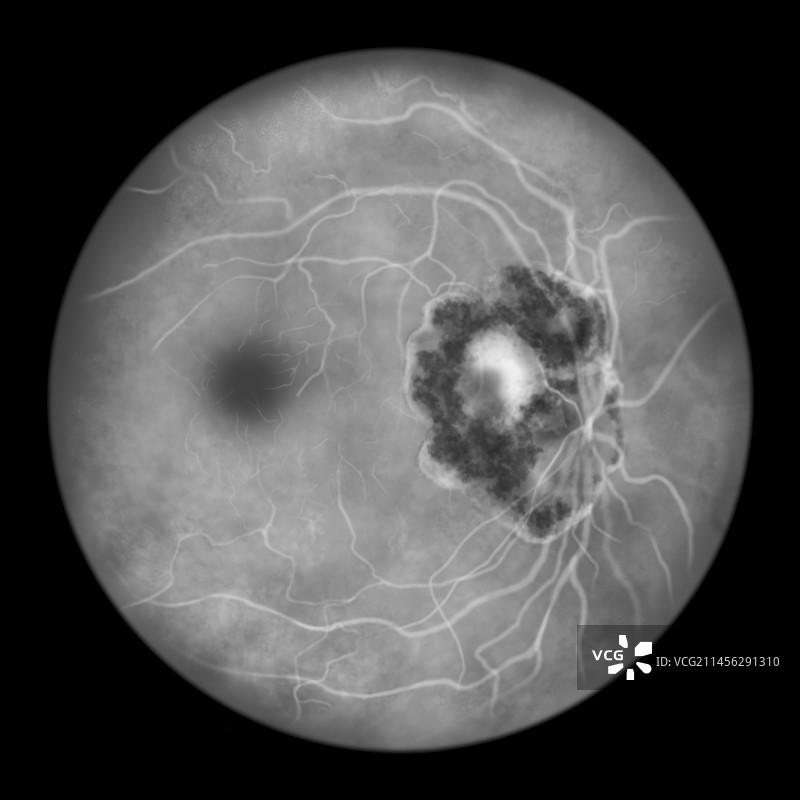 弓形虫病引起的视网膜疤痕插图图片素材