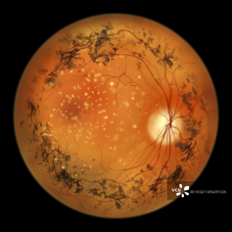 色素性视网膜炎图示图片素材