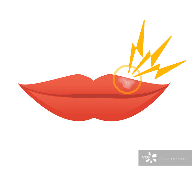 唇疱疹插图图片素材