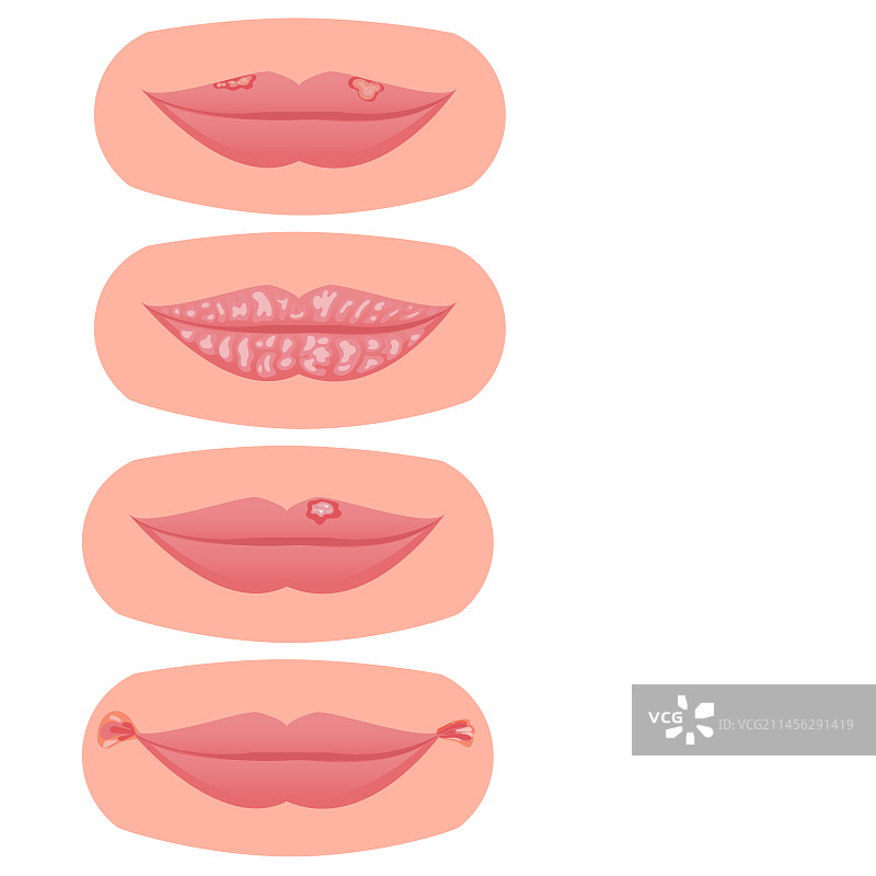 唇部疾病插图图片素材