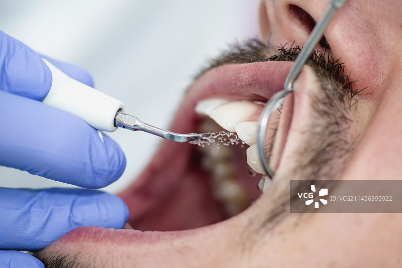 去除牙结石图片素材