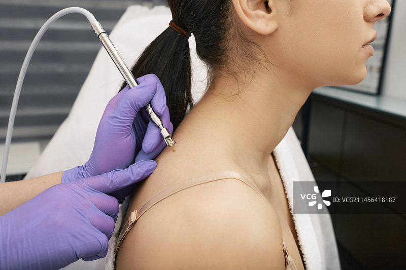 去除痣图片素材