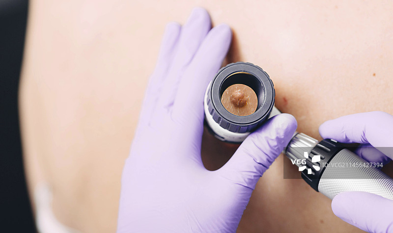 痣皮肤镜检查图片素材