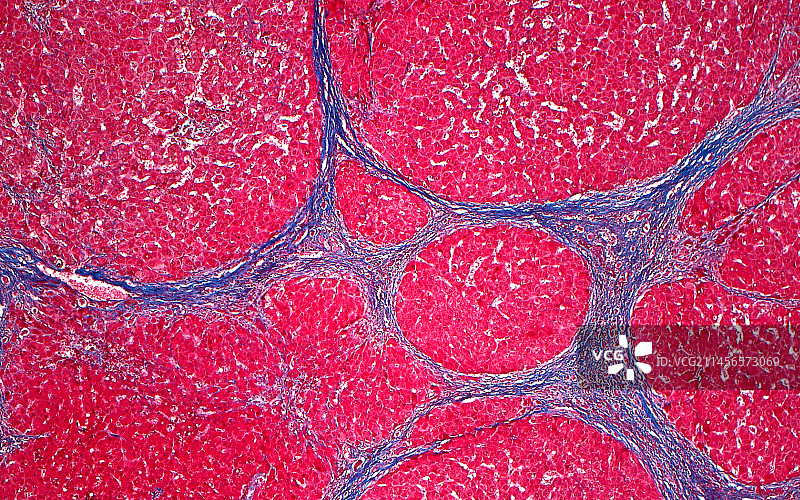 肝硬化光学显微照片图片素材