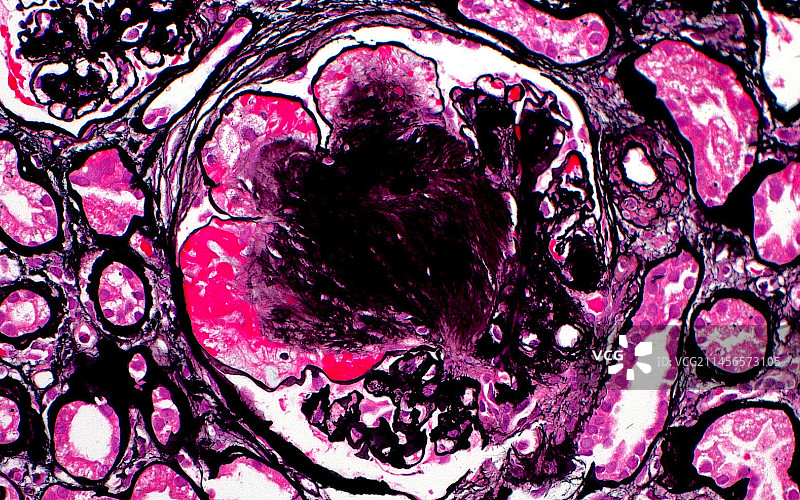 糖尿病肾脏光显微照片图片素材