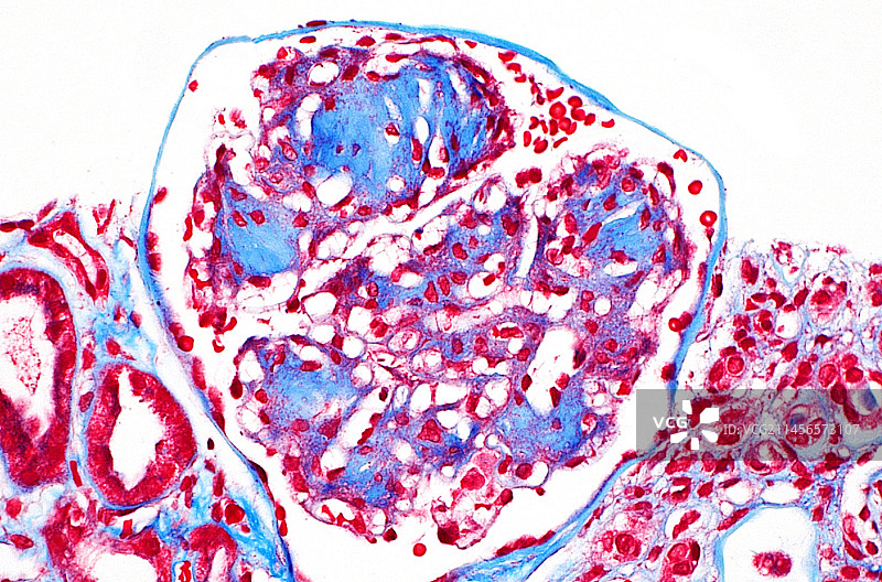 糖尿病肾脏光显微照片图片素材
