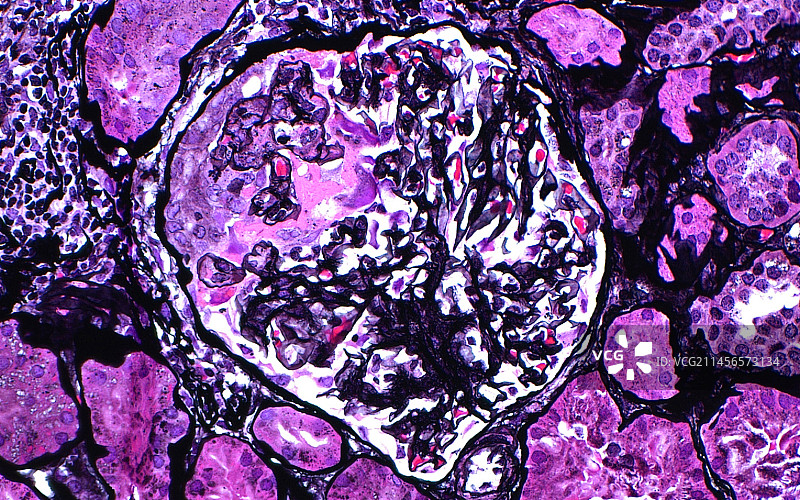 肾小球新月体光镜图图片素材