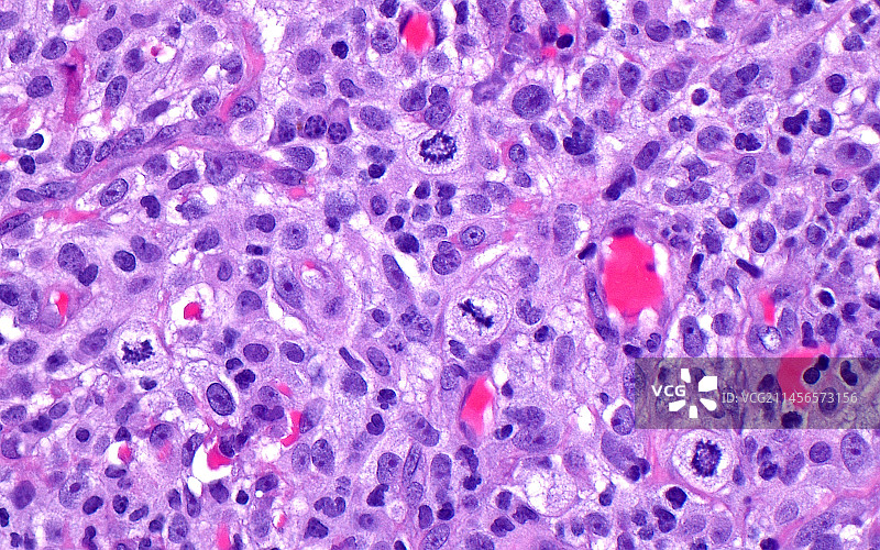 膀胱癌显微照片图片素材