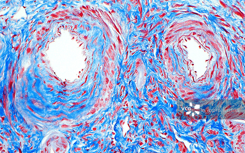 高血压肾脏疾病显微照片图片素材