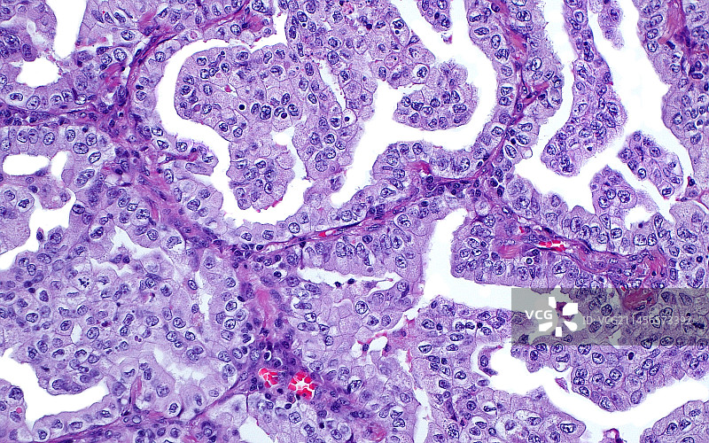 肺癌显微照片图片素材