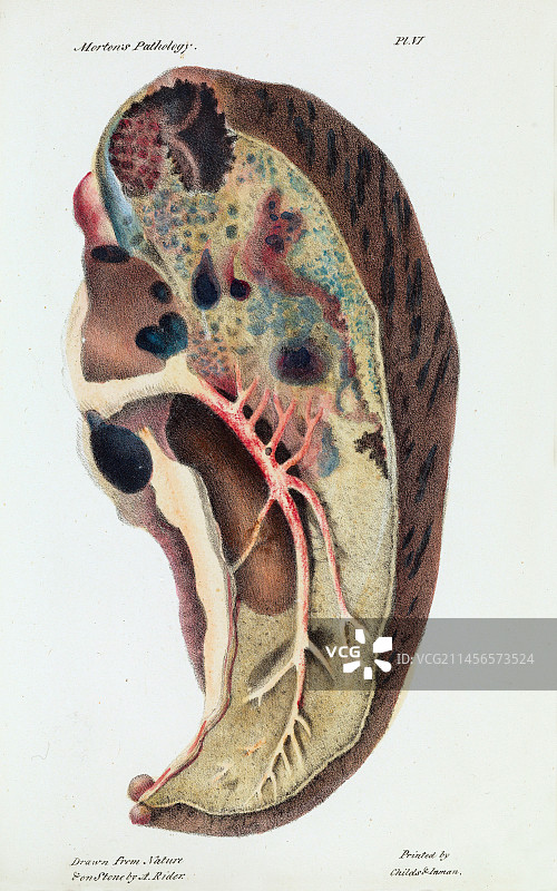 19世纪肺部结核病感染图图片素材