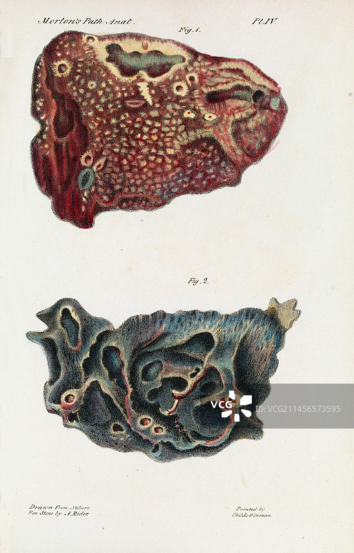 19世纪肺结核感染插图图片素材