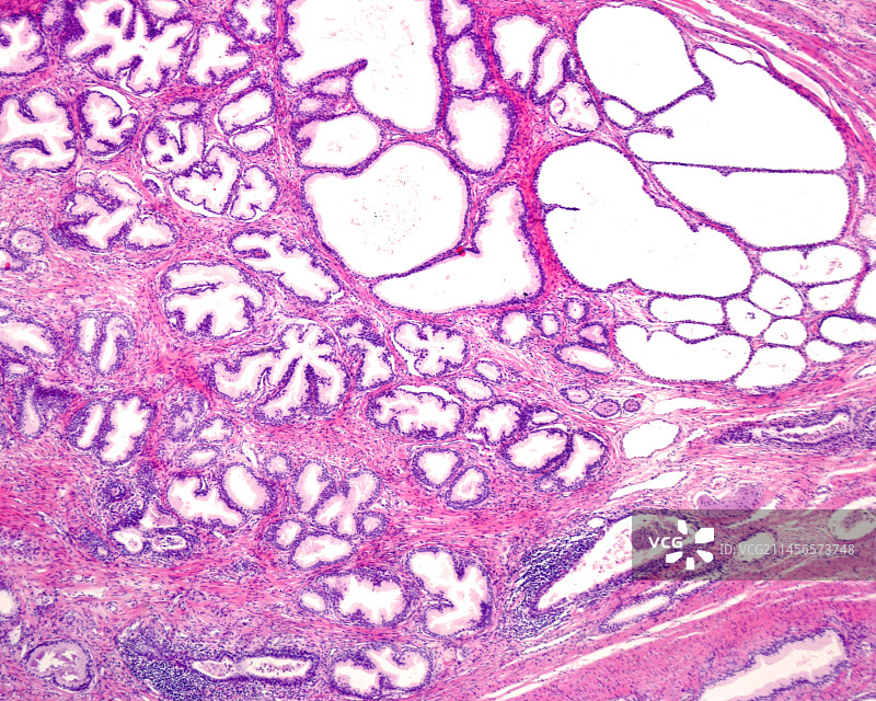 良性前列腺增生，光学显微照片图片素材