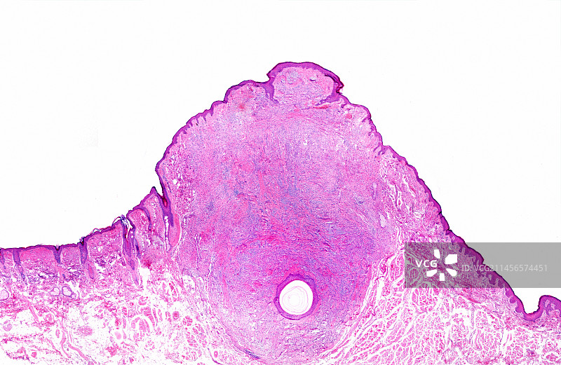 人嘴唇上的痣，光学显微镜照片图片素材
