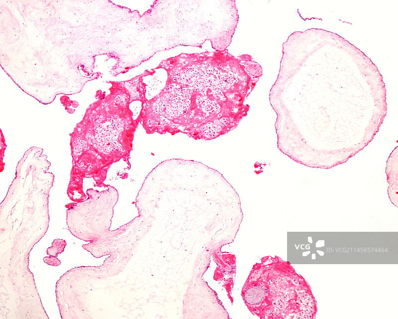 葡萄胎，光学显微照片图片素材