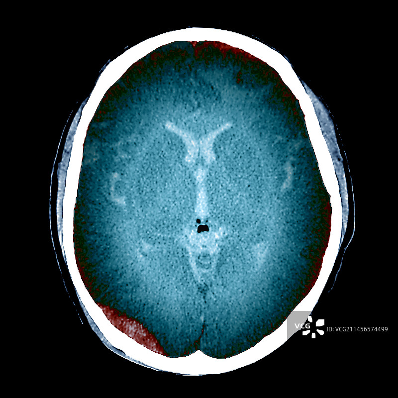 交通事故后的脑损伤CT扫描图片素材