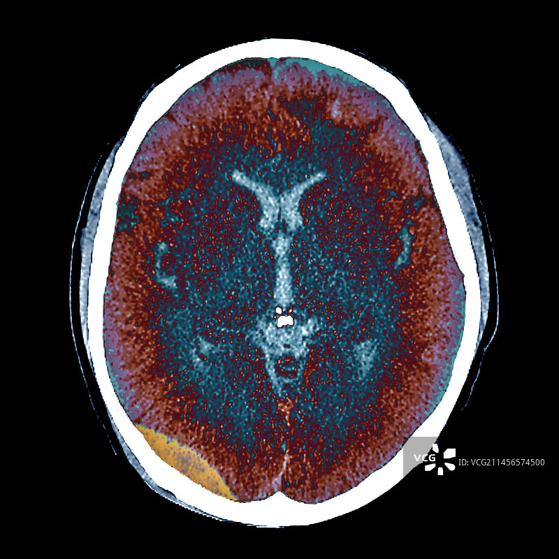 交通事故后的脑损伤CT扫描图片素材