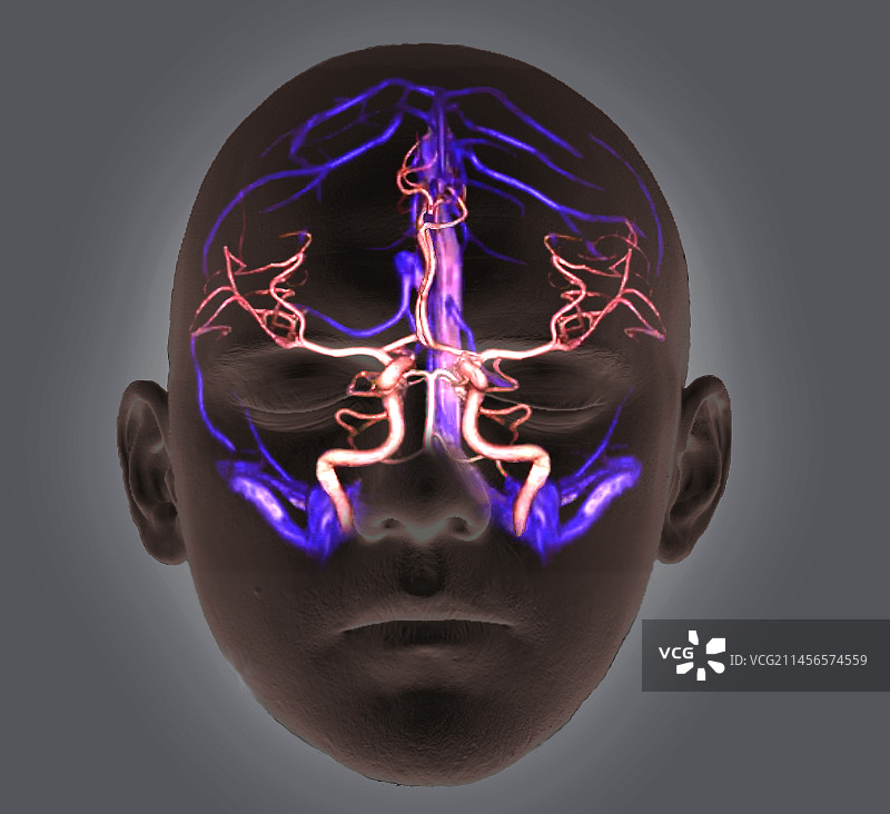 脑血管CT扫描图片素材