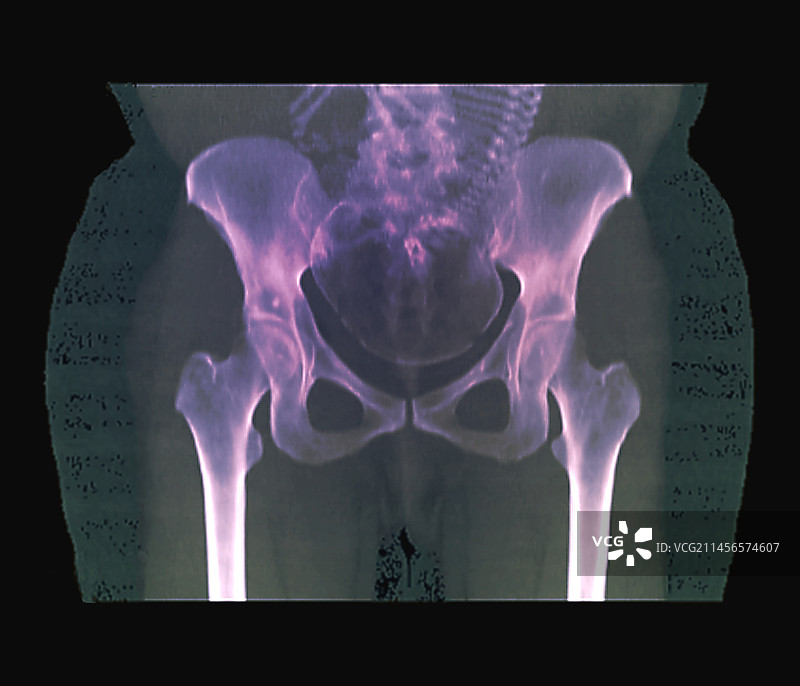 怀孕32周的CT扫描图片素材