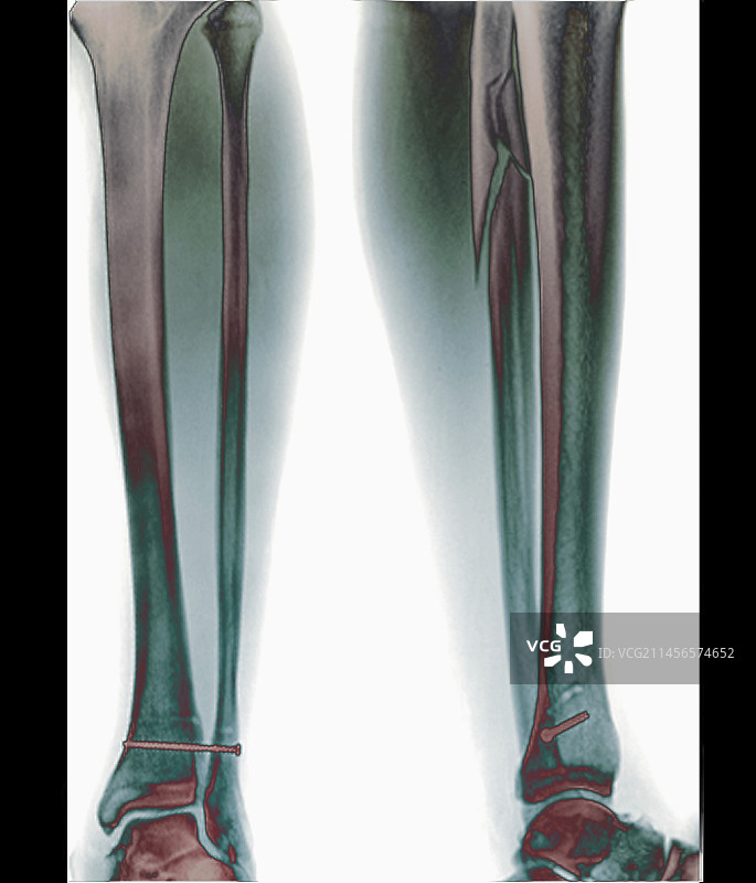 踝关节骨折X光片图片素材