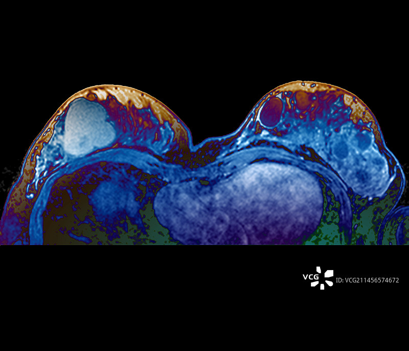 异常乳腺组织核磁共振扫描图片素材
