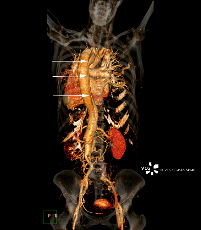 主动脉夹层CT扫描图片素材