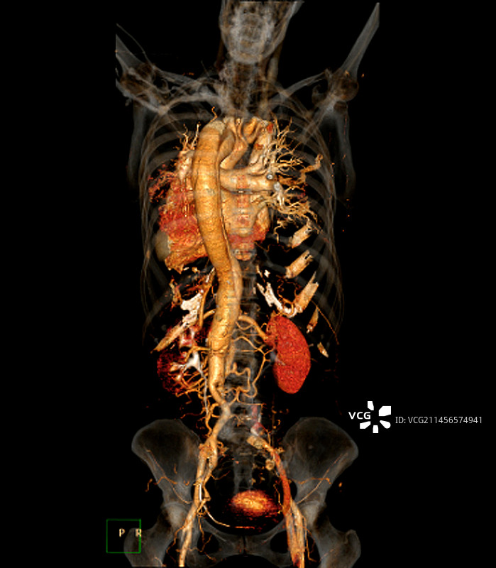 主动脉夹层CT扫描图片素材