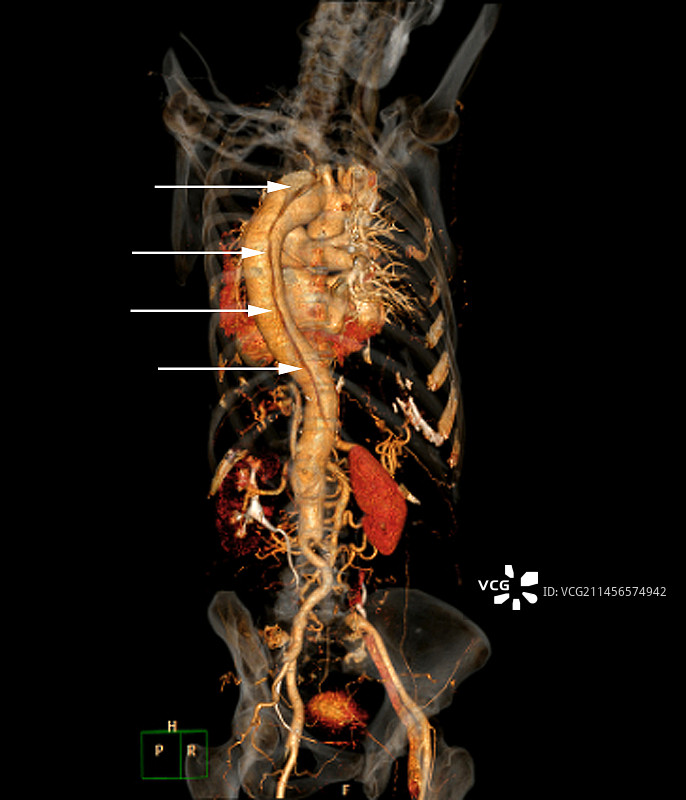 主动脉夹层CT扫描图片素材