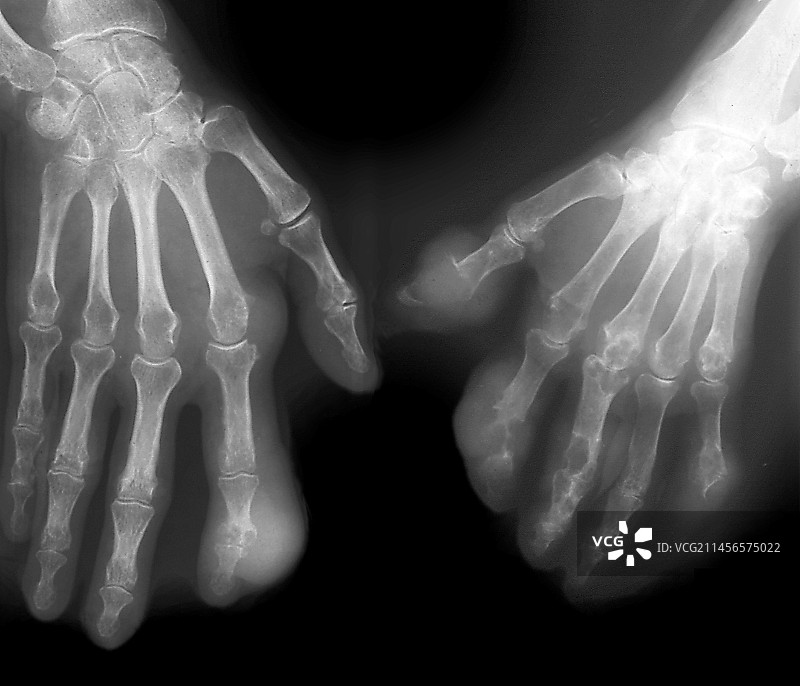 痛风X光片图片素材