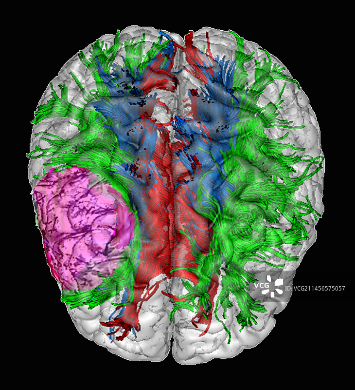 脑损伤，DTI核磁共振扫描图片素材