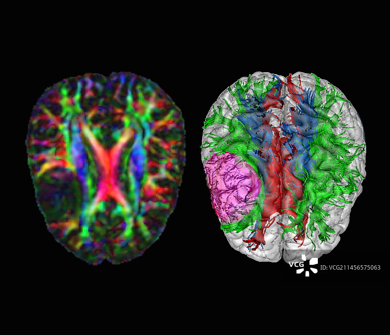 脑损伤DTI核磁共振扫描图片素材