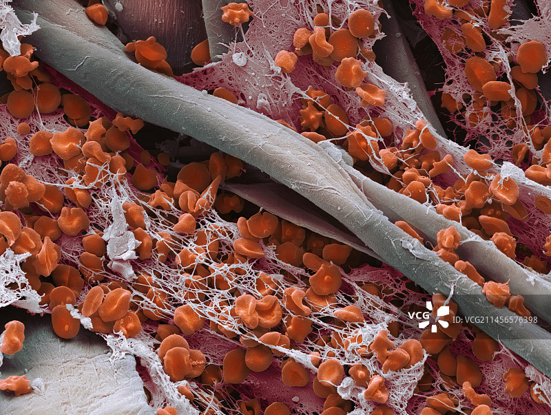 纱布上的血凝块，扫描电镜图片素材