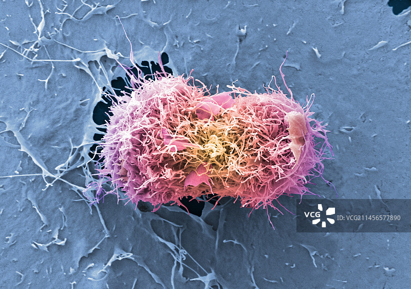 宫颈癌细胞分裂，扫描电镜图片素材