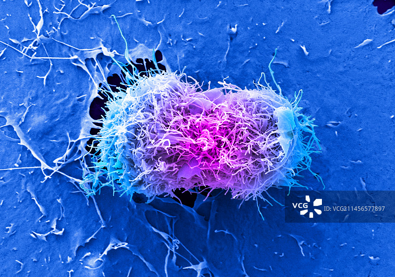 宫颈癌细胞分裂，扫描电镜图片素材