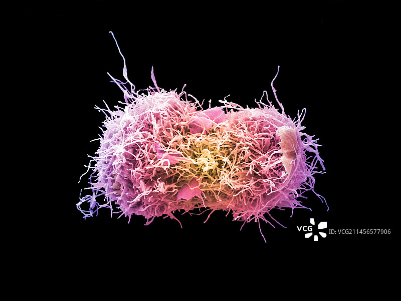 宫颈癌细胞分裂，扫描电镜图片素材