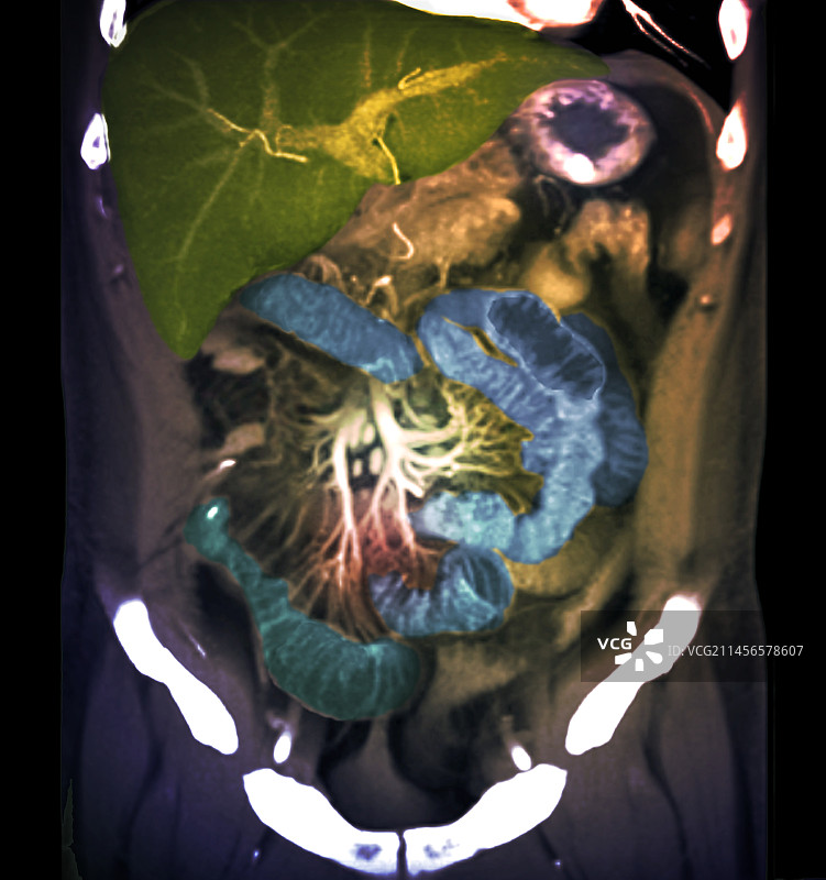 腹部CT扫描图片素材