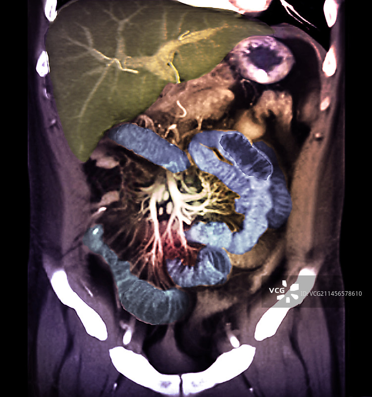 腹部CT扫描图片素材