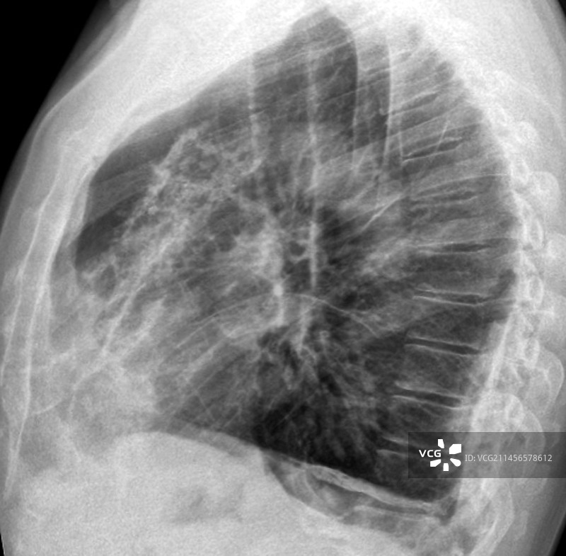石棉肺X光片图片素材