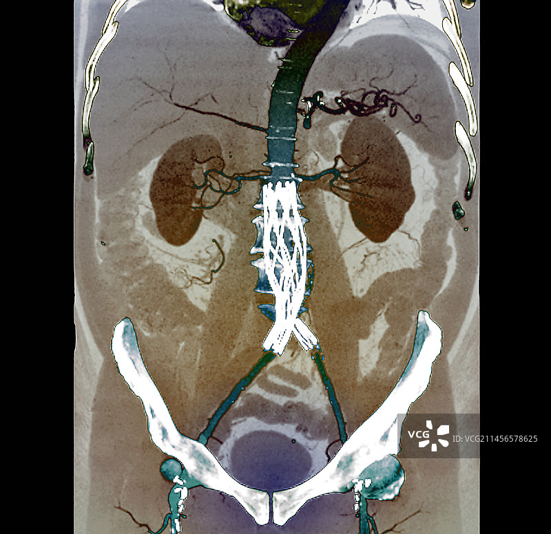 主动脉瘤支架CT扫描图片素材