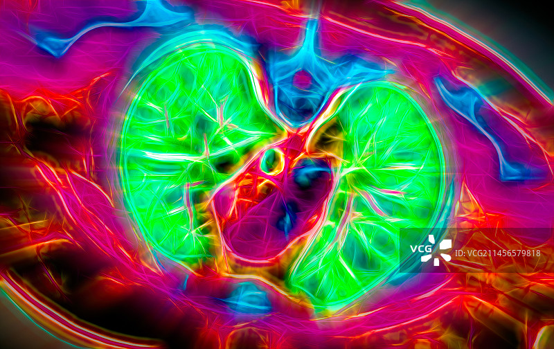 健康的肺部CT扫描图片素材