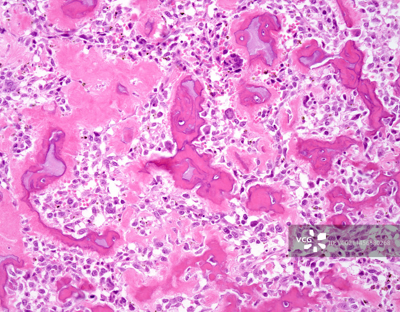 成骨细胞性骨肉瘤显微照片图片素材