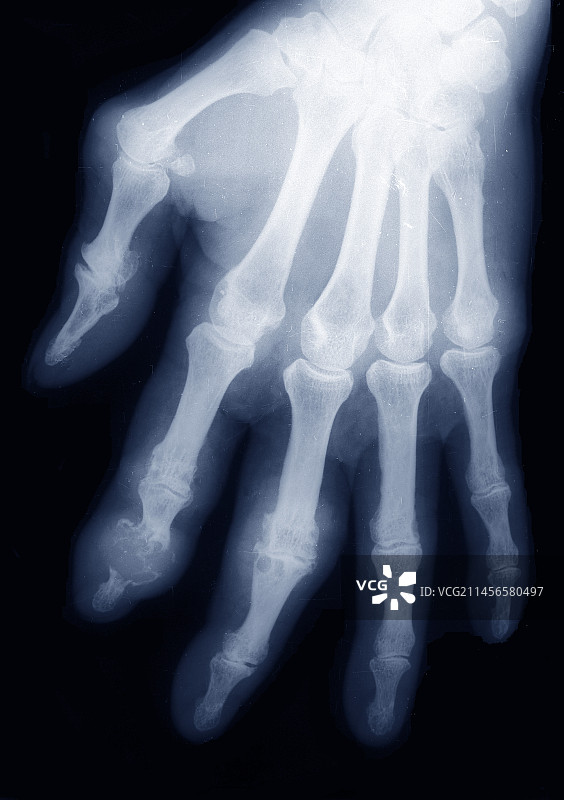 痛风X光片图片素材