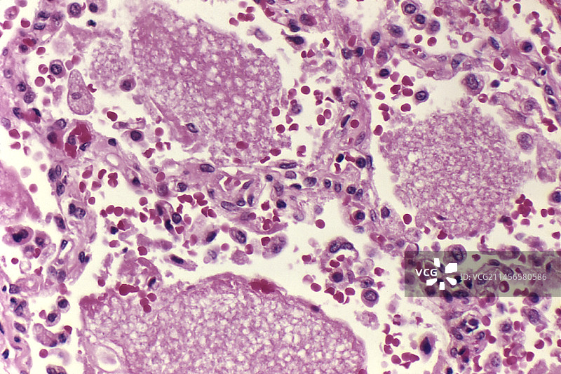 肺组织中的卡氏肺孢子虫真菌图片素材