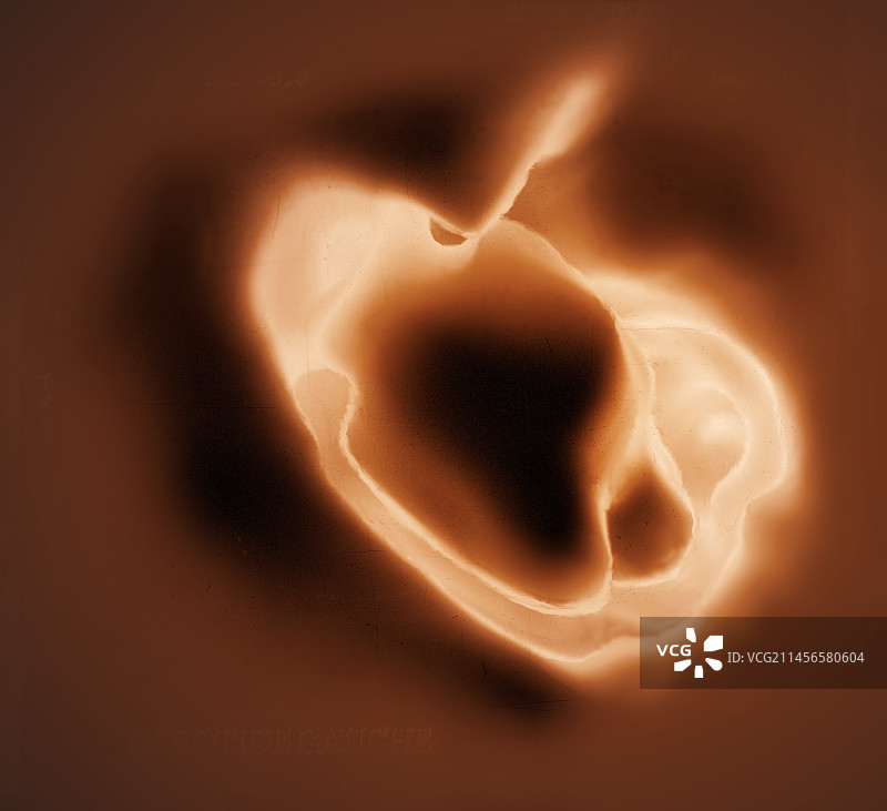 颈动脉中的血凝块3D CT扫描图片素材