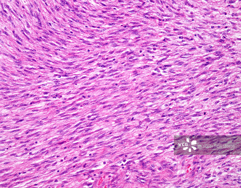 纤维肉瘤，光学显微照片图片素材