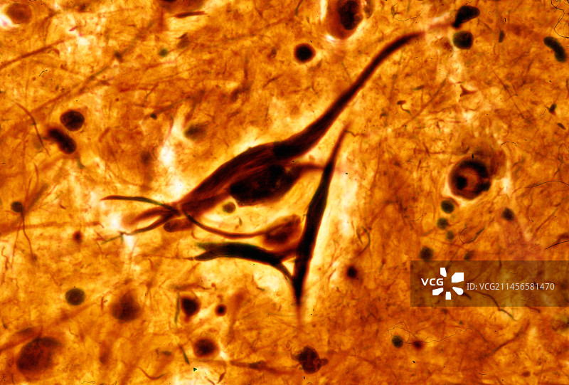 锥体神经元中的神经原纤维缠结，光学显微照片图片素材