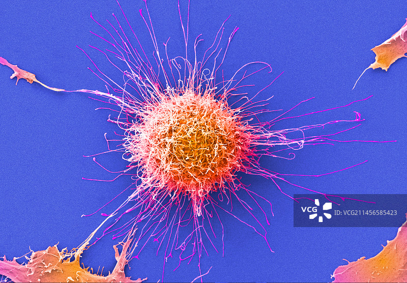 宫颈癌细胞，扫描电子显微镜图片素材